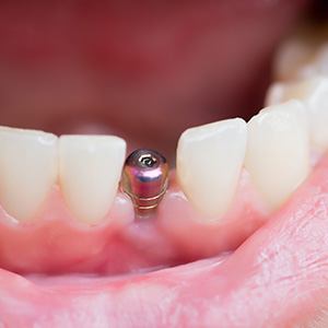 Close-up of unrestored dental implant in gums between natural teeth