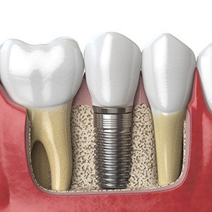 Illustration of dental implant with crown in gums