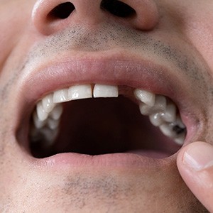 Closeup of a missing tooth