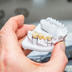 Dental bridge on a clay model