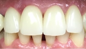 Healthy smile with repaired chip and removed tooth decay