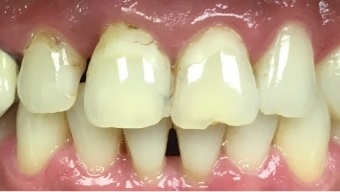 Chipped front teeth with decay around the gums