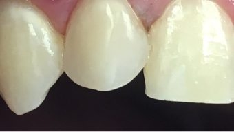 Closeup of top tooth after natural-looking dental restoration