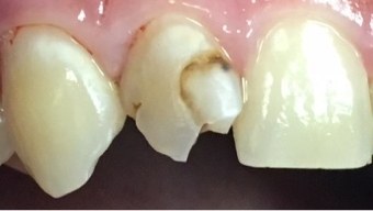 Broken and decayed top tooth