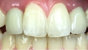 Closeup of smile with two missing teeth after dental implant restoration