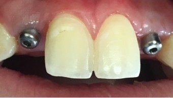 Closeup of smile with two missing teeth after dental implant post placement