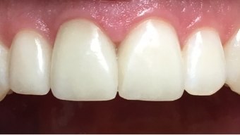 Whitened top two front teeth