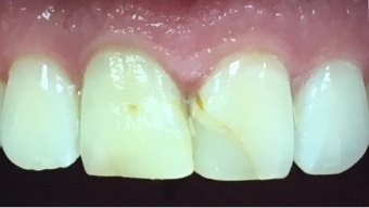 Discolored top two front teeth