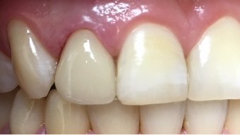 Closeup of healthy smile after gum tissue restoration