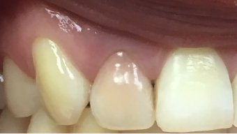 Closeup of damaged smile with gum tissue recession