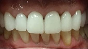 Closeup of a healthy smile after gum tissue restoration