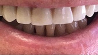 Closeup of flawless smile with natural looking dental restoration