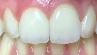 Closeup of smile with repaired teeth and gums