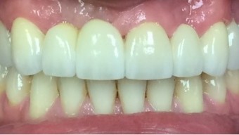 Repaired and replaced teeth after dental restoration