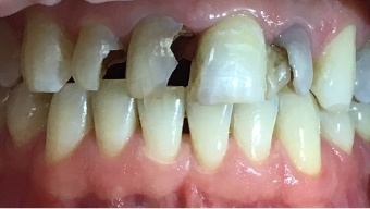 Severe tooth decay and broken teeth