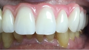 Smile after dental implant restoration