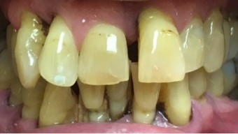 Severely yellowed and damaged smile