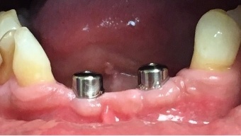 Closeup of damaged smile before dental treatment