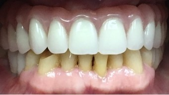 Closeup of smile after missing tooth is replaced with a dental implant