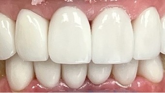 Closeup of smile after dental implant tooth replacement