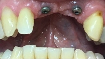 Missing top teeth with dental implant posts visible