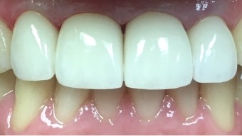 Bright smile after teeth whitening