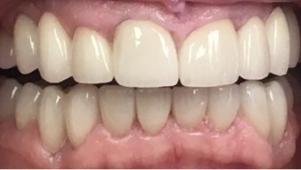 Closeup of flawless smile after full mouth dental restoration