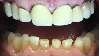 Smile with extensive damage and unnatural looking dental restoration