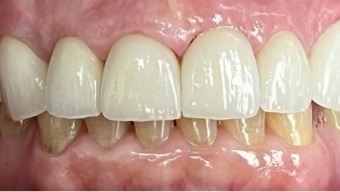 Healthy smile after tooth replacement