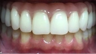 Bright healthy smile with decay repaired