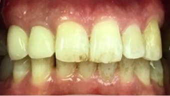 Yellowed teeth with decay and damage