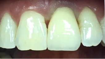 Closeup of healthy smile after dental restoration