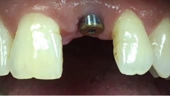 Closeup of smile with severe tooth decay